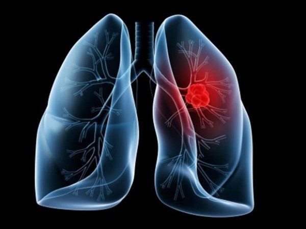 cancer-pulmonar-600x450